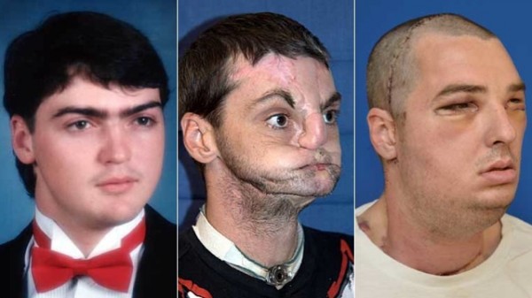 Transplante facial bem sucedido.