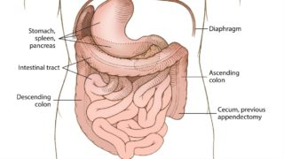 Ilustração da condição rara situs inversus com levocardia