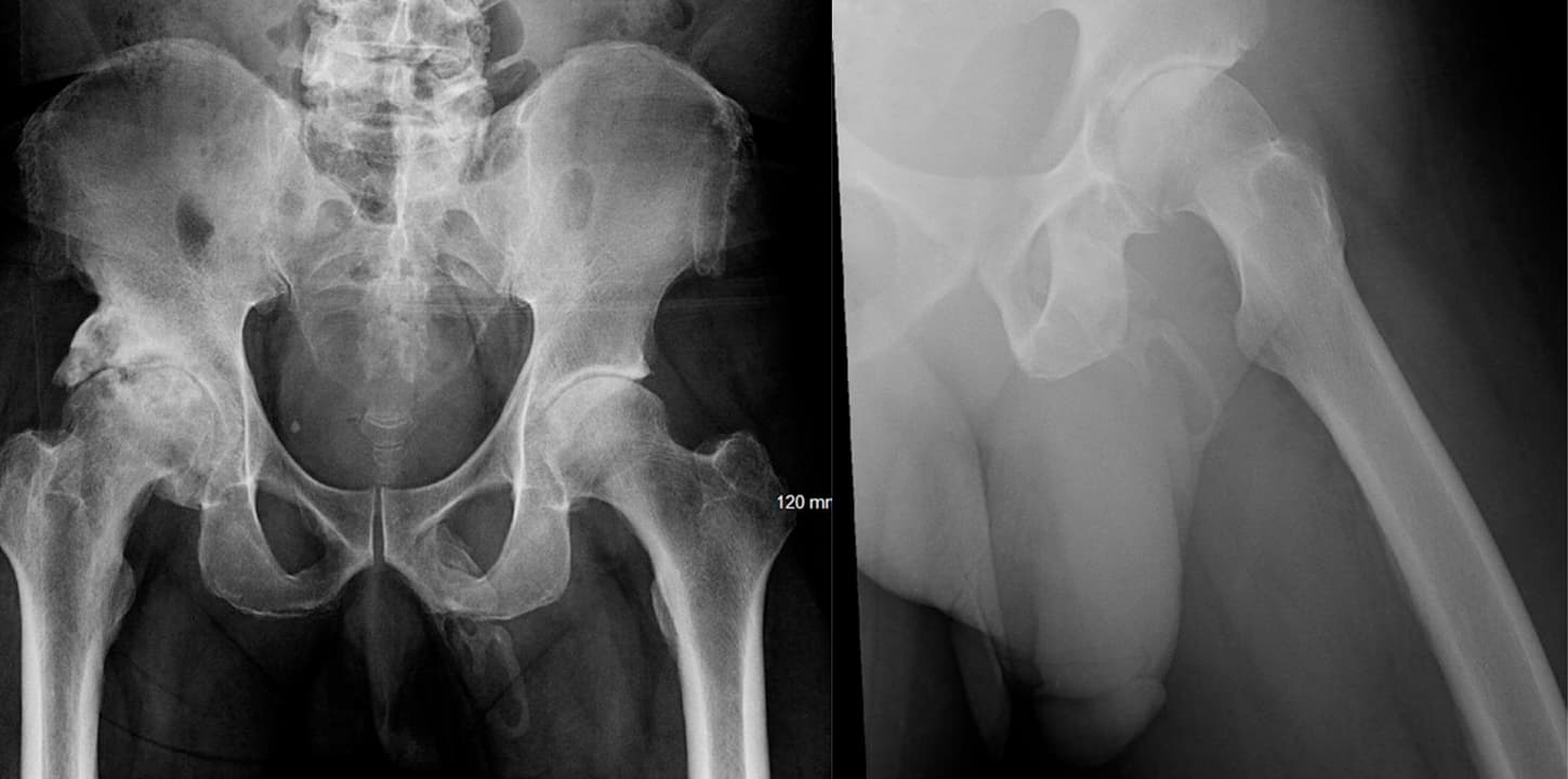 Imagens de raio-x do paciente com calcificação peniana 