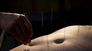 Barriga de uma pessoa com agulhas de acupuntura