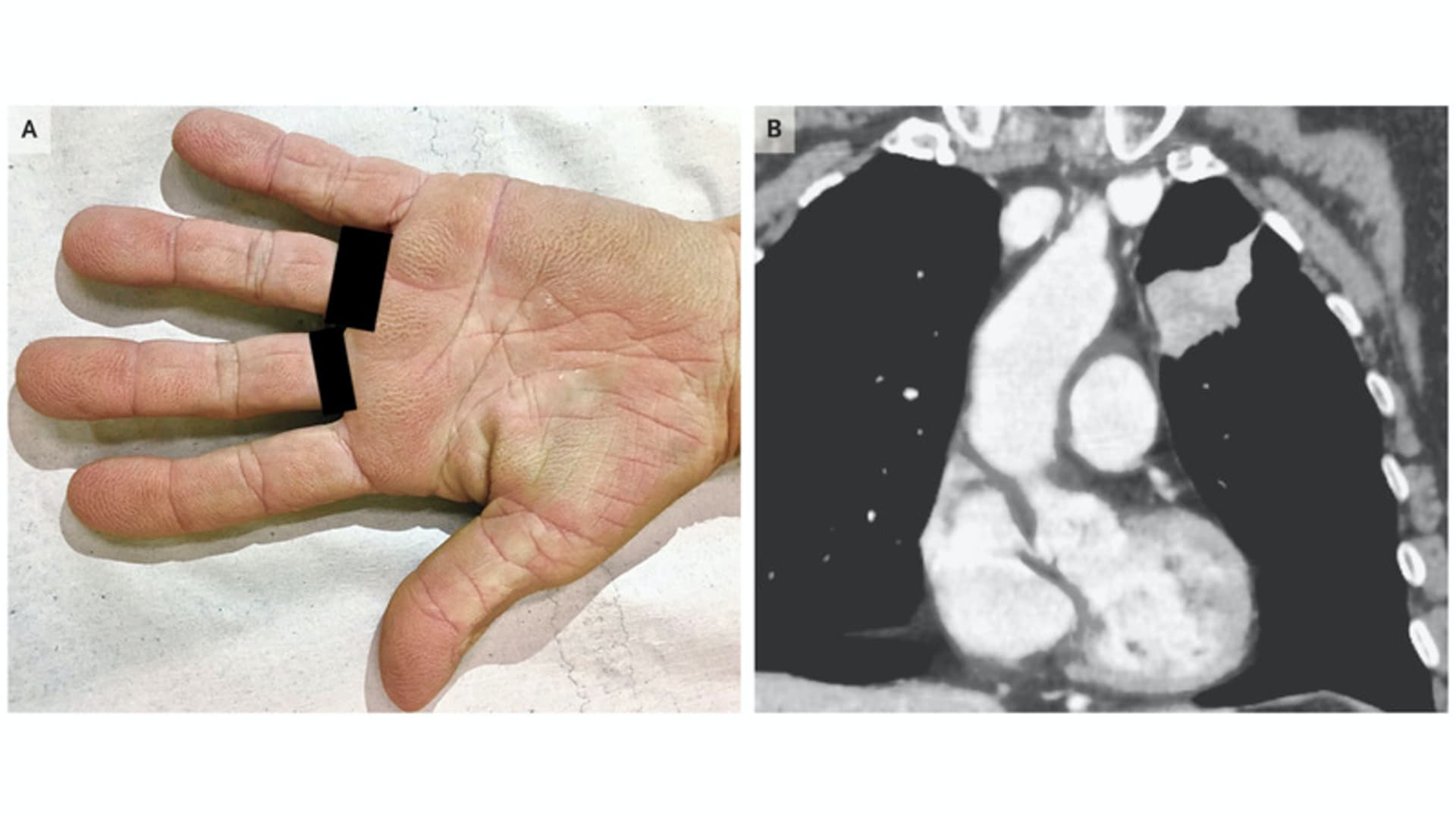 A mão da brasileira ao lado da imagem da tomografia computadorizada. Crédito: Denis Miyashiro, M.D., e Jose A. Sanches/New England Journal of Medicine)