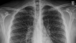 Raio-x de tórax de um rapaz de 17 anos, feita dois dias após a internação hospitalar, mostrando sinais de "pulmão de pipoca"