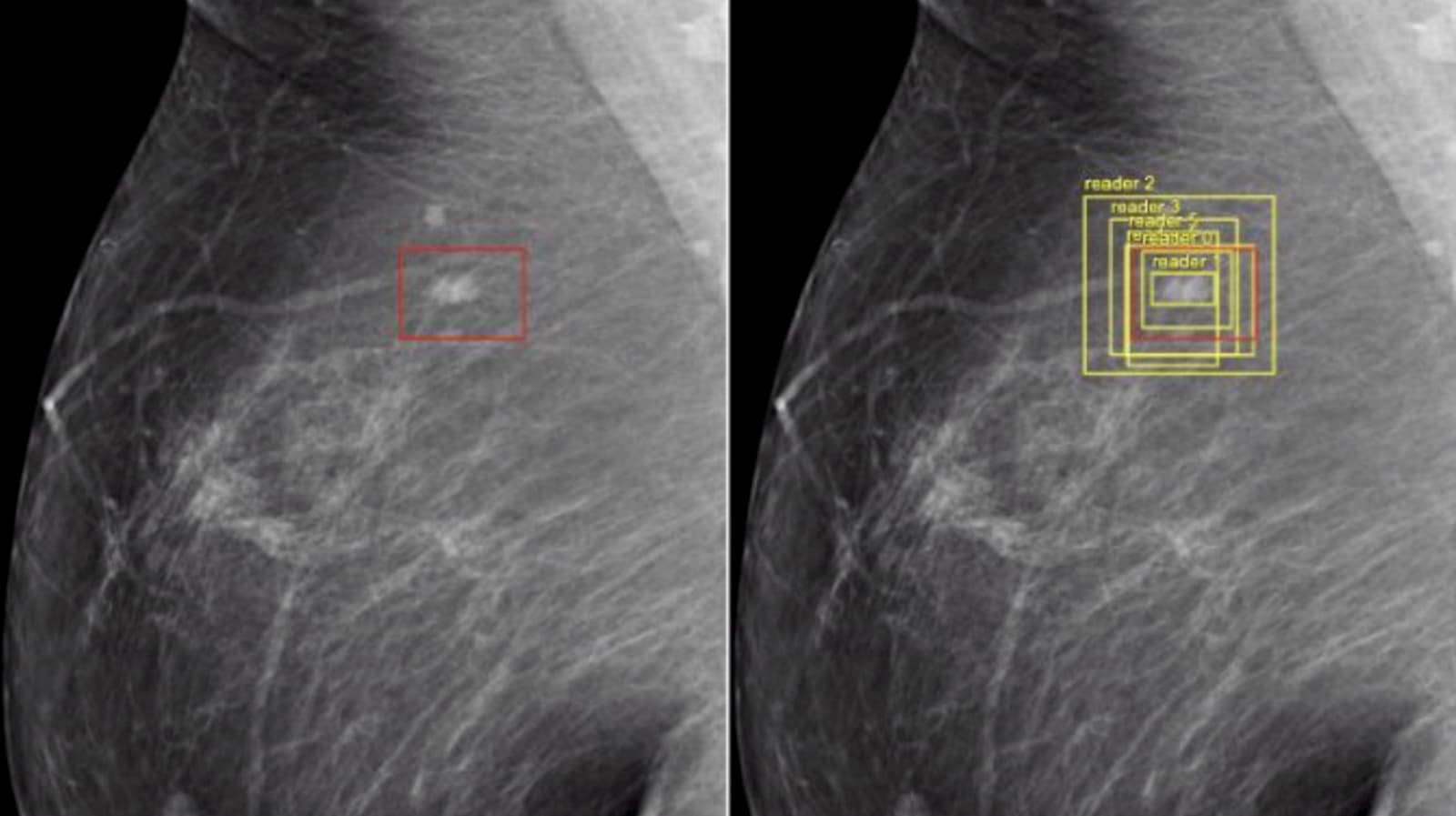 Imagens de inteligência artificial analisando mamografia