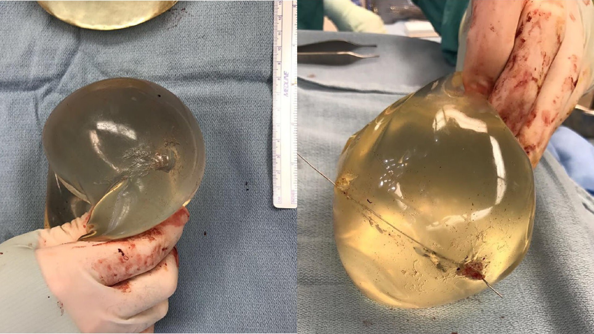 Implantes de silicone da mulher atingida. Repare que o trajeto da bala pode ser visto em cada um deles. Crédito: McEvenue, et al (Plastic Surgery Case Studies (CC BY NC 4.0)