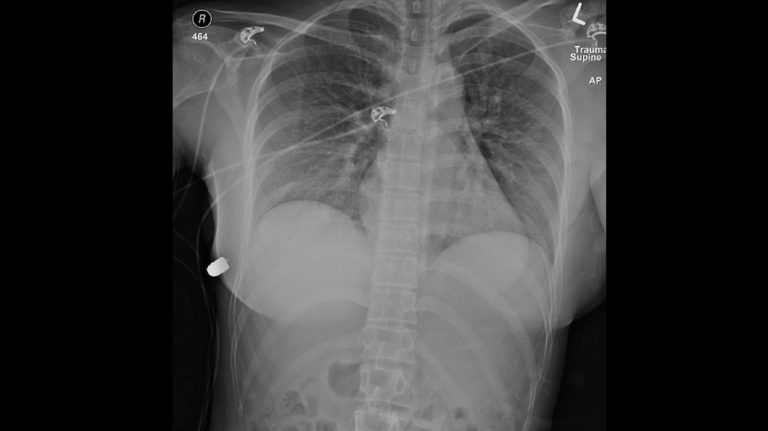 Radiografia mostra bala que atingiu a mulher, no lado esquerdo superior. Crédito: McEvenue, et al (Plastic Surgery Case Studies)