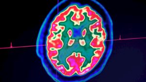 Imagem de cérebro humano tirada por um tomógrafo de emissão de pósitrons, também chamado de PET scan