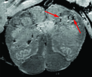 Imagem em alta resolução de tecido cerebral de paciente com COVID-19. Imagem: NIH