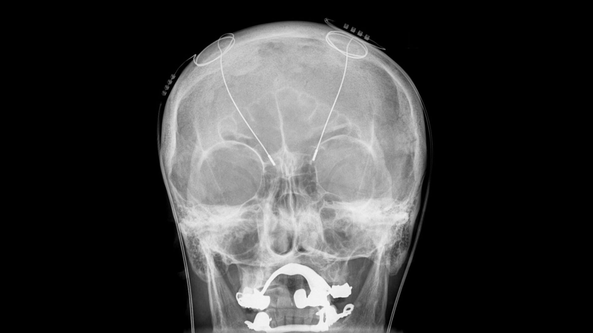 O Raio X de um dispositivo de estimulação cerebral profunda . Imagem: Hellerhoff / Wikimedia Commons
