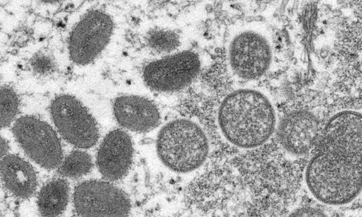 Sintomas e transmissão varíola dos macacos - Imagem mostra vírus visto através de microscópio.