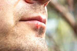 Foto mostra lábios de homem afetados pela herpes.