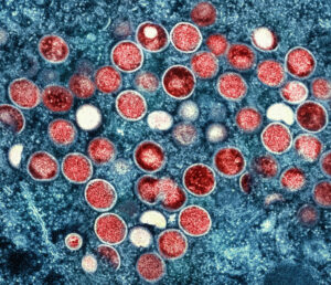 Imagem microscópica mostra vírus causador de varíola dos macacos (vermelho) em células infectadas (azul).