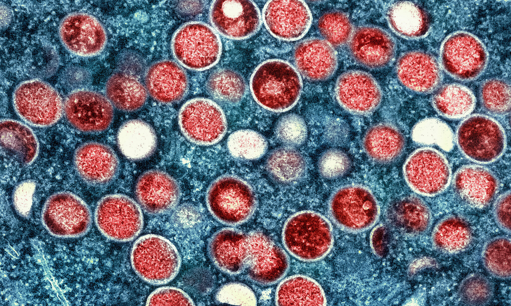 Imagem microscópica mostra vírus causador de varíola dos macacos (vermelho) em células infectadas (azul).