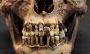 Aparelho do passado: aristocrata do século 17 usava fios de ouro para prender seus dentes
