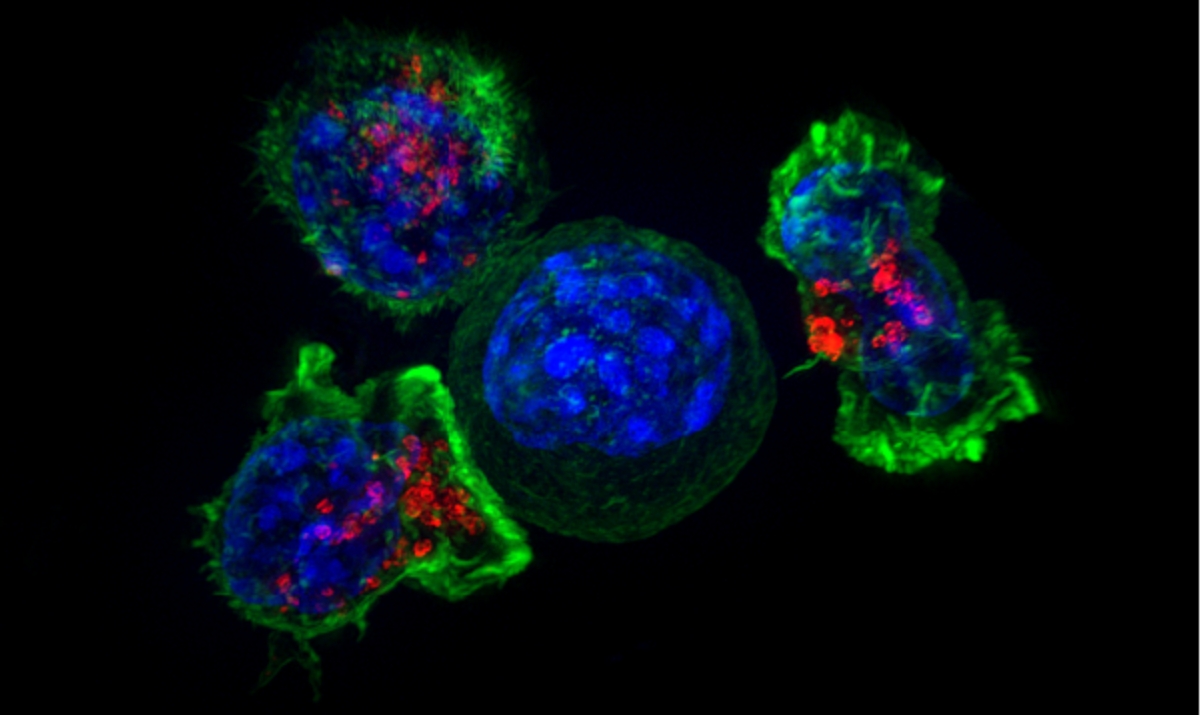 células T ao redor de célula cancerígena. elas podem ser mais eficazes com a terapia car-t cell, afirmam cientistas