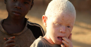 Mudanças climáticas representam uma ameaça aos albinos de Malawi