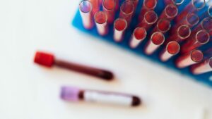 Processo utilizado para diagnóstico de câncer de sangue reduz gastos com leucemia infantil no Brasil