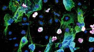 Estudos identificam ações das células de defesa que lesam o organismo na sepse