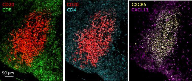 Tumor de pâncreas contendo uma estrutura linfoide terciária madura. Nas duas primeiras imagens à esquerda, núcleo de linfócitos B (em vermelho) e zona externa de linfócitos T CD8/CD4 (em azul e verde, respectivamente). Na terceira imagem, linfócitos T reativos ao tumor produzem a quimiocina CXCL13 (em rosa), que atrai linfócitos B CXCR5+ (em amarelo)