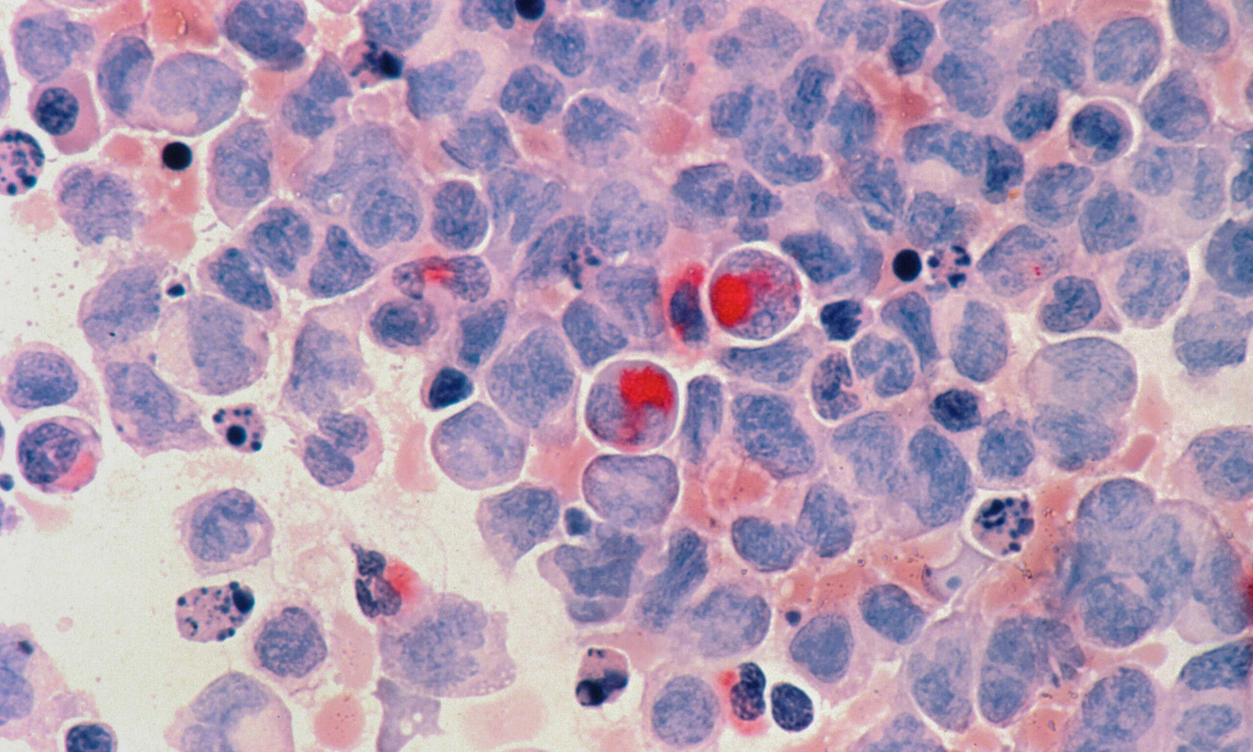 Anvisa autoriza estudo clínico de terapia celular para leucemias e linfomas