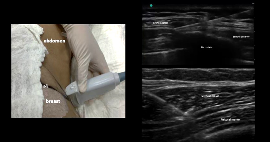 No procedimento, o aparelho de ultrassom (à esq.) localiza a região a ser bloqueada (à dir.) e, a seguir, o anestésico local é injetado com uma agulha, bloqueando a área e impedindo a sinalização da dor 