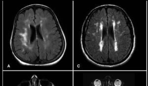 Implantes cerebrais podem ajudar recuperação de traumas na cabeça, diz estudo