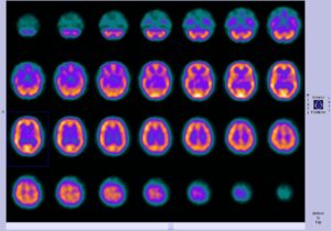 Cientistas avançam em tratamento de Parkinson feito com ímãs no cérebro