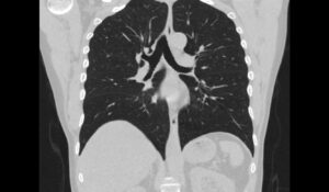 IA agora pode detectar Covid-19 em imagens de ultrassom pulmonar