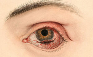 Novo método de terapia fotodinâmica pode erradicar o melanoma ocular, mostra estudo