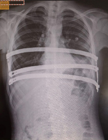 Radiografia de tórax com esquema de três barras utilizadas na correção do pectus carinatum - 