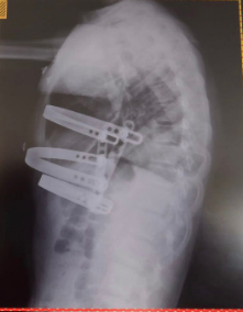 Radiografia em perfil onde a barra do meio tem posição mais elevada por estar por cima do osso - 