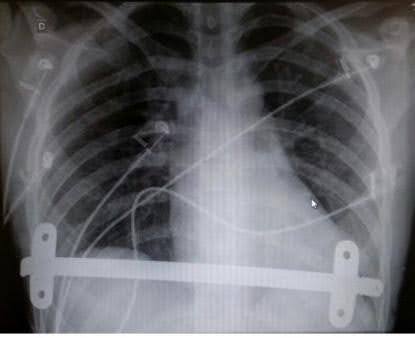 Radiografia mostra barra e estabilizadores importados inseridos no paciente 