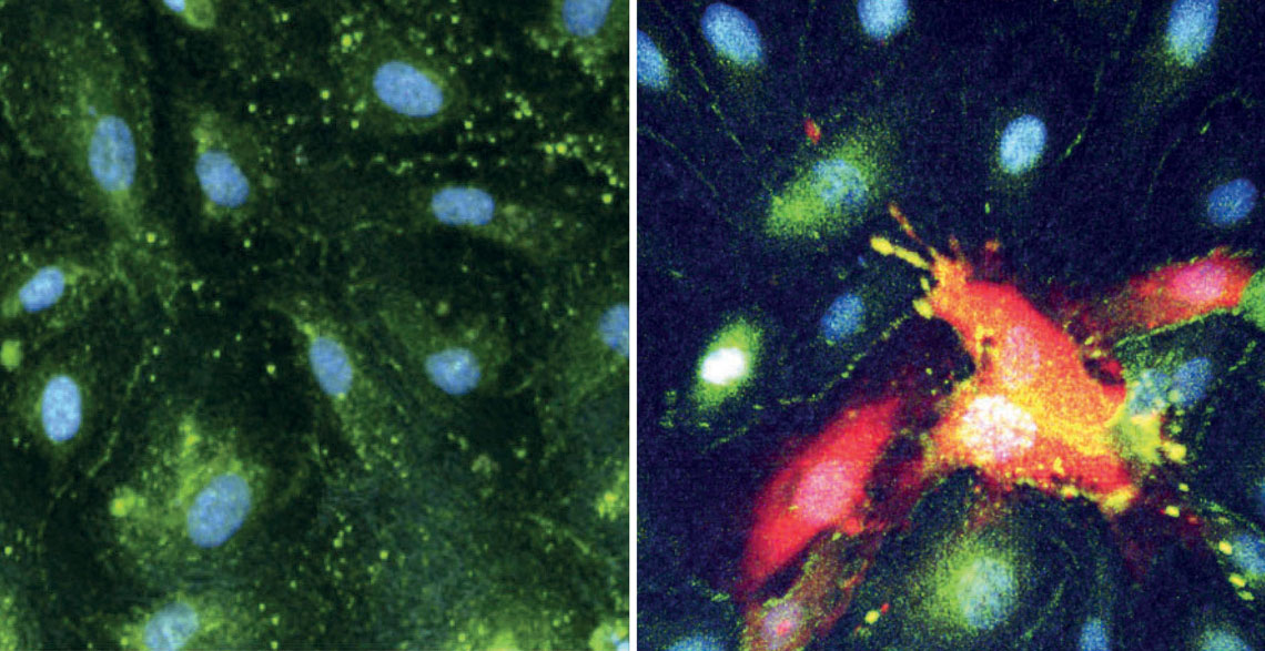 Células do revestimento de vasos sanguíneos do cérebro íntegras (à esq.) e infectadas pelo CHIKV e destruídas (à dir., em vermelho)
