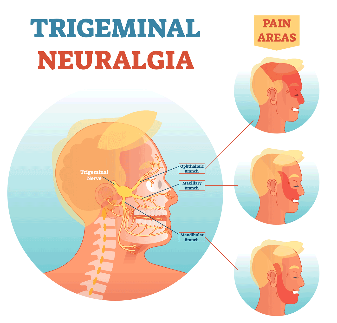 A neuralgia do trigêmeo ocorre pela inflamação do nervo trigêmeo 