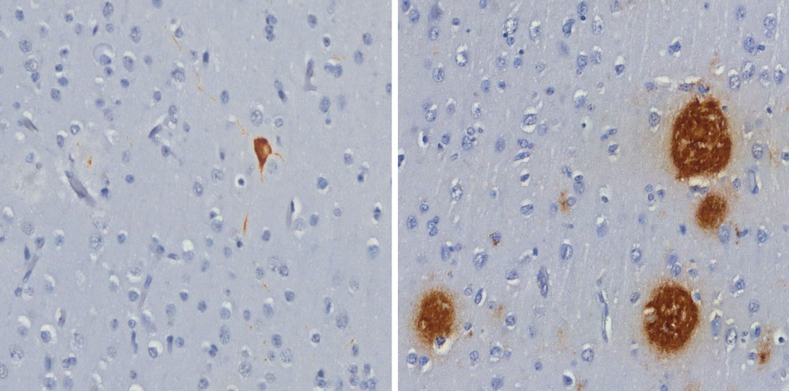 Emaranhado de proteína tau (à esq.) e placas de peptídeo beta-amiloide (à dir.), ambos em marrom, encontrados no cérebro de macacos-prego.
