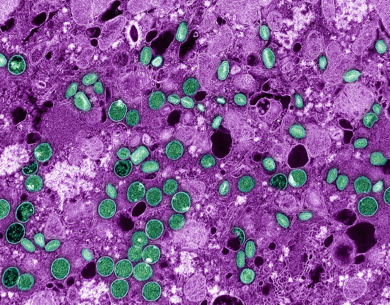 Mpox: quais os sintomas e como a doença é transmitida