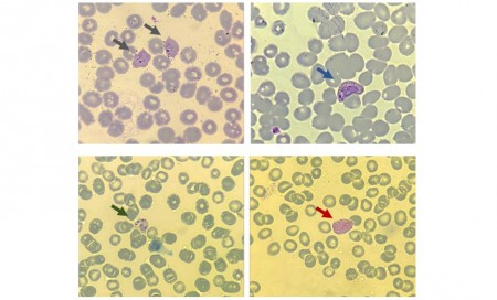 Imagens ilustrativas de Plasmodium vivax. As setas indicam os estágios sanguíneos assexuados de anel (cinza), trofozoíto (azul), esquizonte (verde) e o estágio sexuado conhecido como gametócito (vermelho) (imagens: Laboratório de Doenças Tropicais/Unicamp)