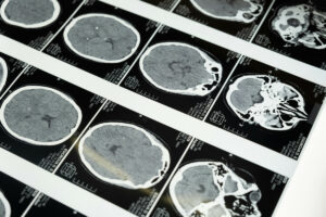 Técnica de medicina nuclear é usada para estudar a doença de Alzheimer em pessoas com síndrome de Down