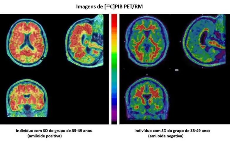 Estudo avaliou o cérebro de indivíduos com síndrome de Down de diferentes faixas etárias (imagem: Daniele de Paula Faria)