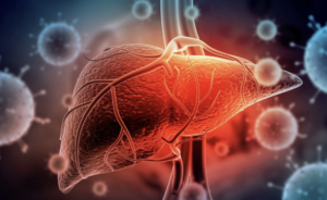 Esteatose hepática: como e por que o acúmulo de gordura no fígado se tornou uma epidemia global e preocupante