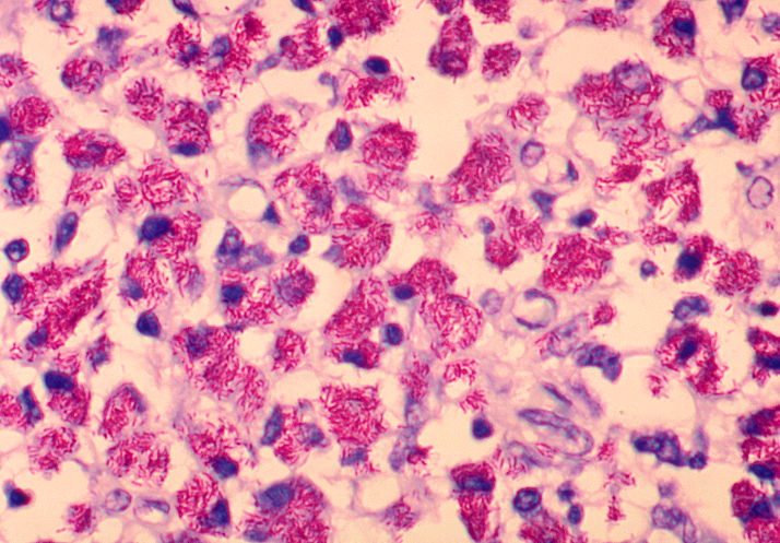 Nova molécula apresenta potencial para tratar infecções pulmonares causadas por microrganismos